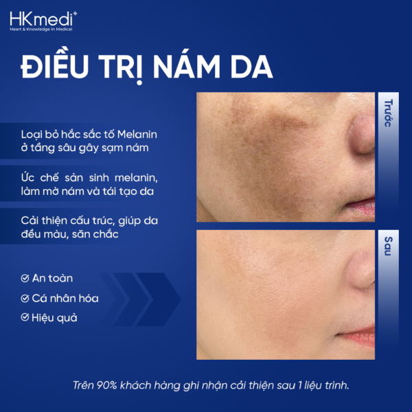 260816 Hậu web ảnh DV nám - Khánh