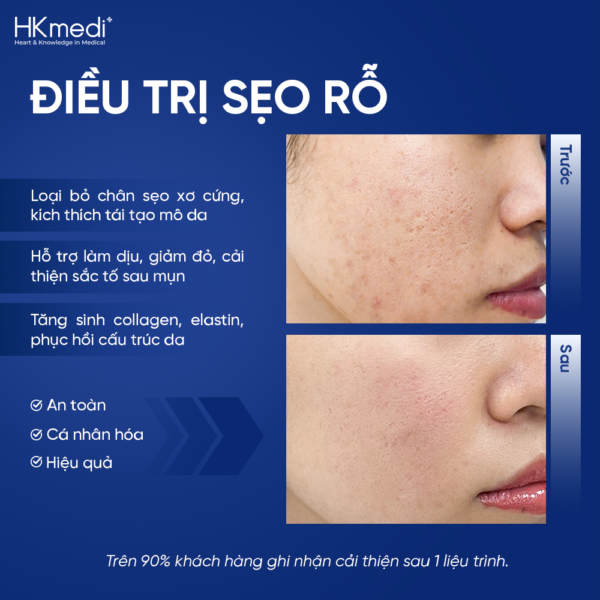 260816 Hậu web ảnh DV sẹo rỗ - Khánh