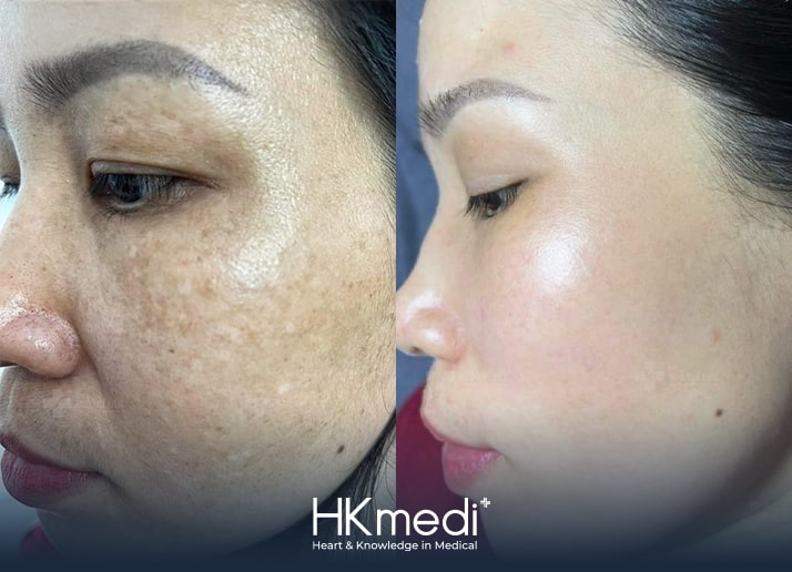 KH điều trị nám