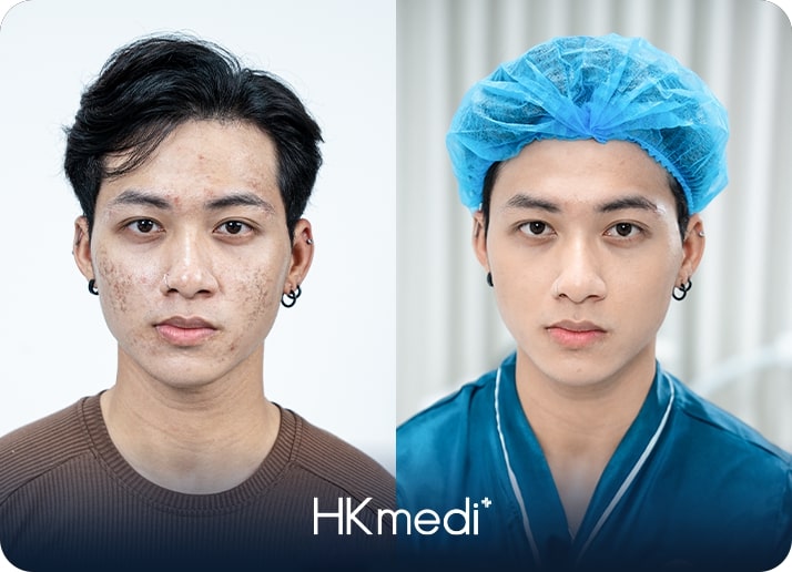 KH điều trị sẹo rỗ