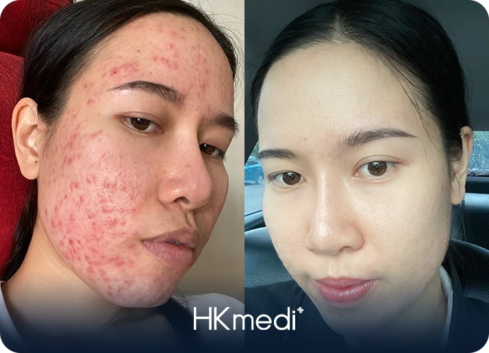 KH trị mụn 2