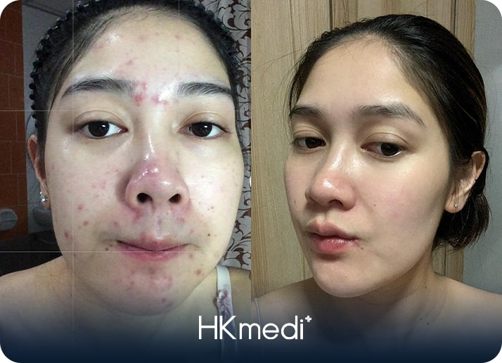 KH trị mụn