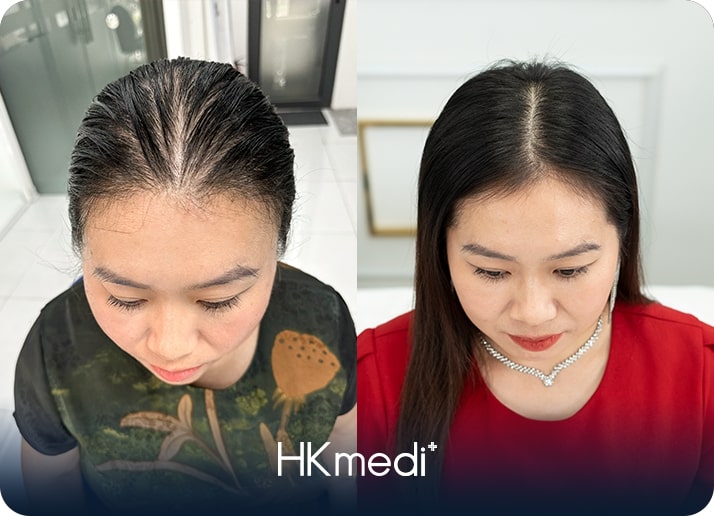 KH trị rụng tóc 2
